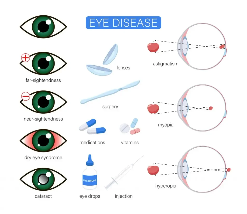 eye diseases or disorder cartoon illustration set