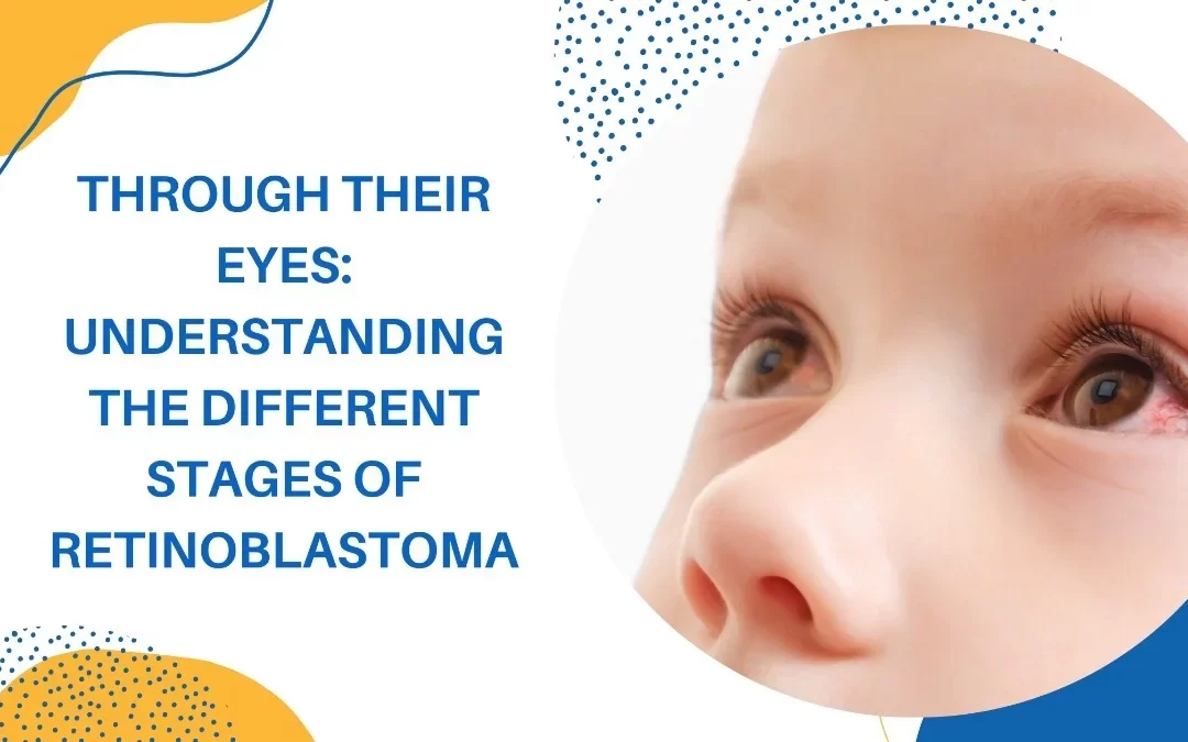 Through Their Eyes: Understanding the Different Stages of Retinoblastoma 