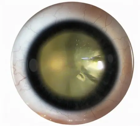 1_types_of_cataract_Traumatic_cataract-1