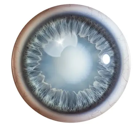 1_types_of_cataract_nuclear_cataract-1