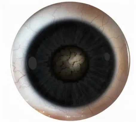 1_types_of_cataract_posterior_subcapsular_cataract-1
