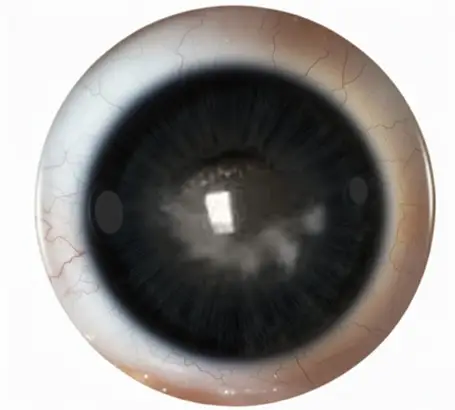 1_types_of_cataract_secondary_cataract-1