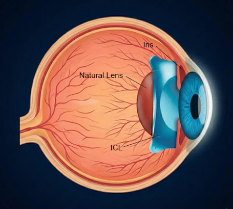 Congenital Cataract