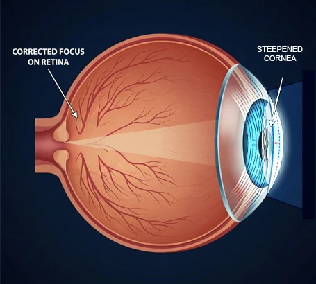 Congenital Cataract