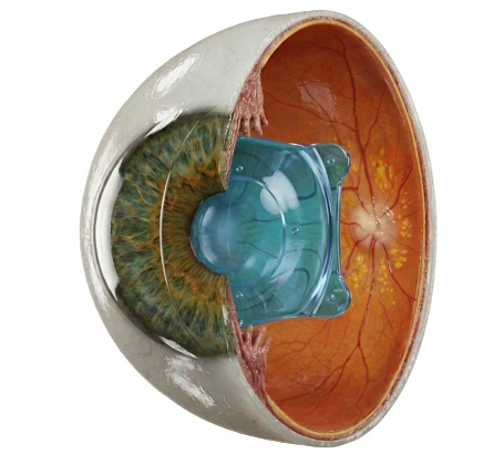 Strabismus (Squint)