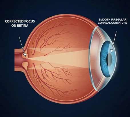 Strabismus (Squint)
