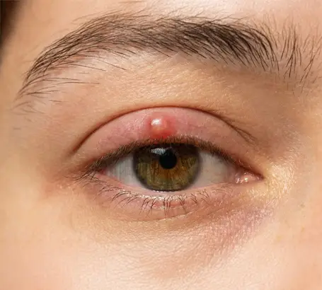A lump, swelling, or growth on the eyelid