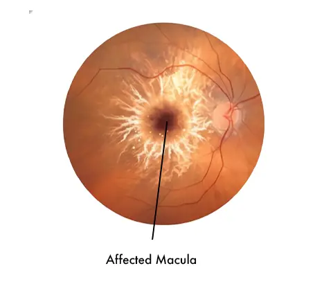 Age-Related Macular Degeneration (AMD)