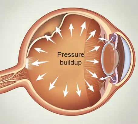 Angle-Closure-Glaucoma