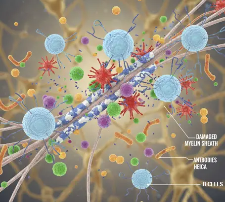 Autoimmune conditions such as multiple sclerosis