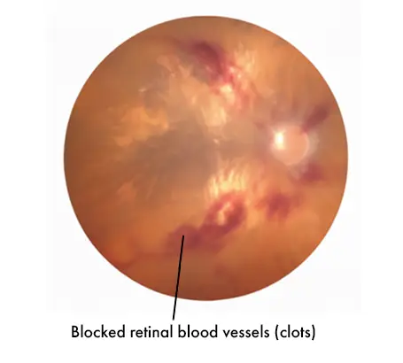 Blocked retinal blood vessels
