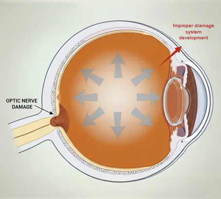 Congenital-Glaucoma