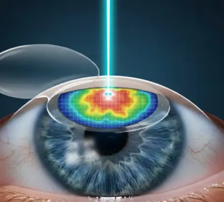Contoura-Vision-LASIK