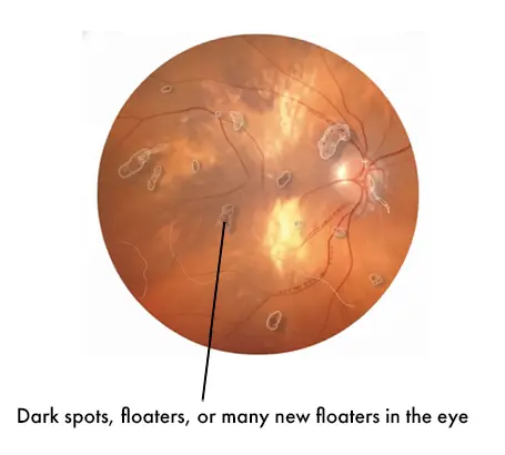 Dark spots or a sudden increase in floaters