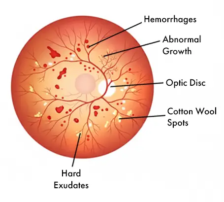 Diabetic Retinopathy