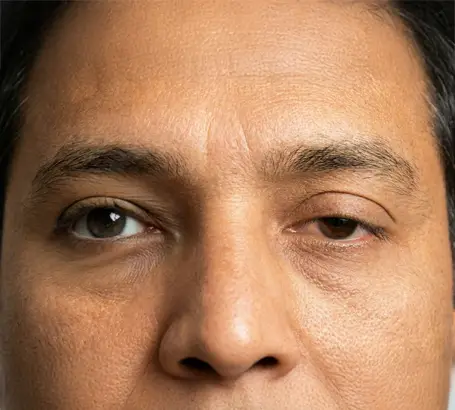 Drooping or sagging eyelids interfering with vision