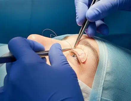 Eyelid Surgery