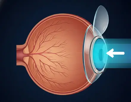 Femtosecond Laser–Assisted Cataract Surgery (FLACS)