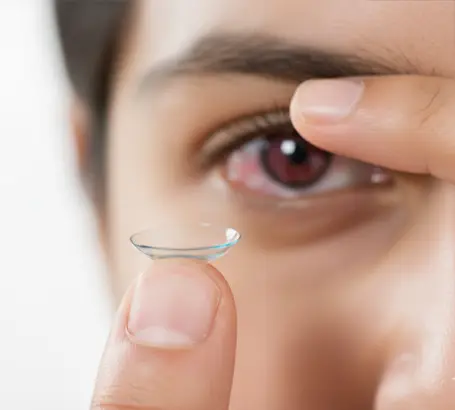 Improper-contact-lens-hygiene-or-overuse