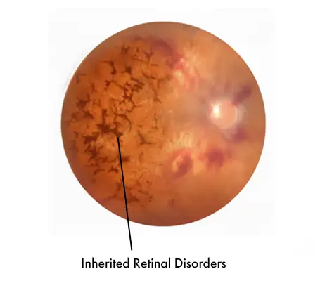 Inherited Retinal Disorders