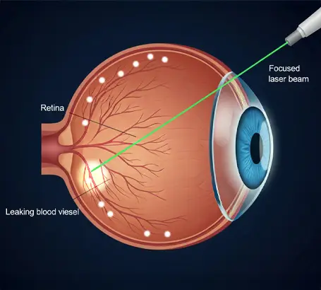 Intravitreal Injections