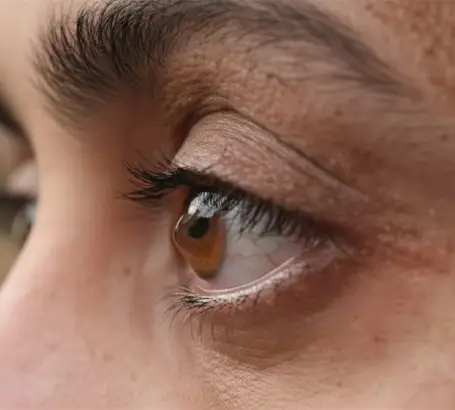 Keratoconus