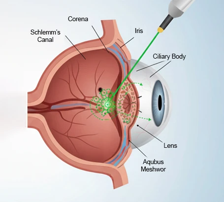 Laser Treatment