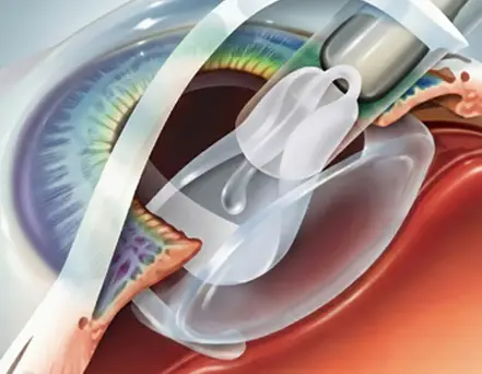Lens Insertion