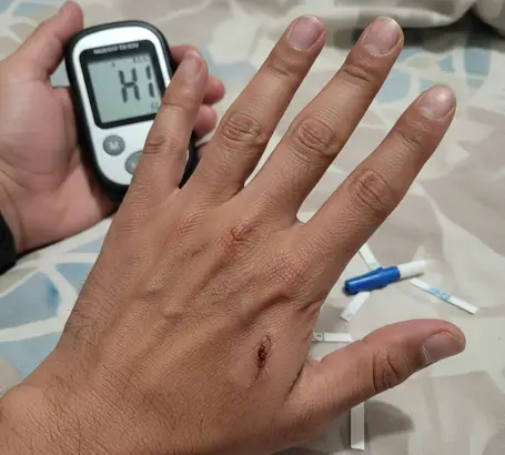Long-standing diabetes