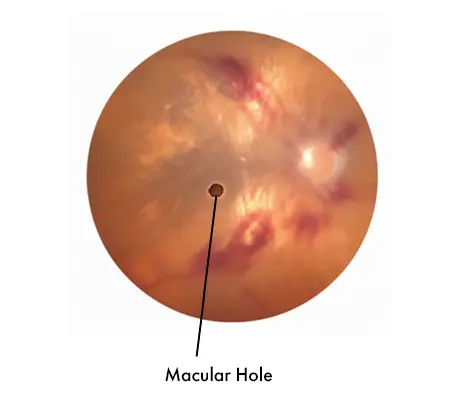 Macular Hole