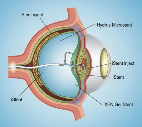 Minimally Invasive Glaucoma Surgery (MIGS)