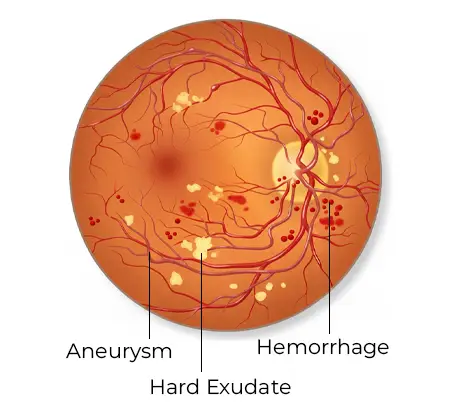 Non-Proliferative-Diabetic-Retinopathy-NPDR