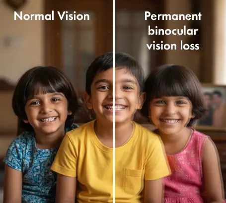 Permanent binocular vision loss