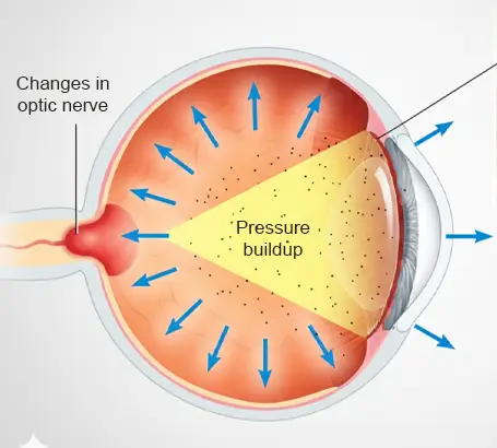 Primary-Open-Angle-Glaucoma