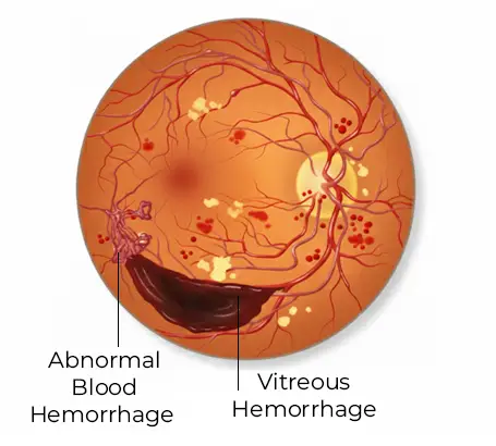 Proliferative-Diabetic-Retinopathy-PDR