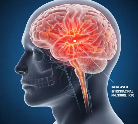 Raised intracranial pressure