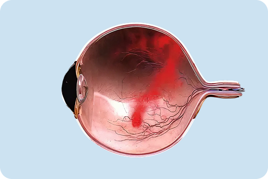 Retinal Disorders