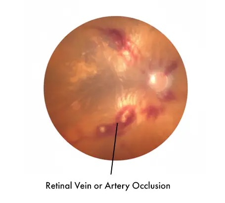 Retinal Vein or Artery Occlusion