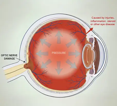 Secondary-Glaucoma