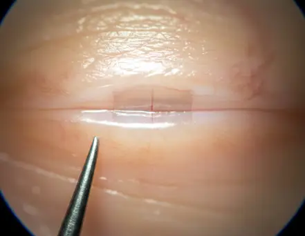 Self-Sealing Incision
