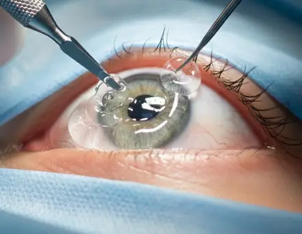 Small corneal incision made