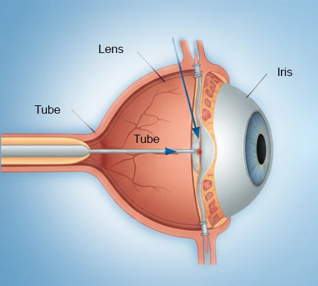 Trabeculectomy _ Glaucoma Drainage Devices