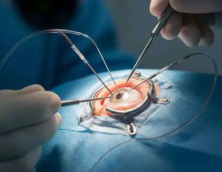 Vitrectomy Surgery
